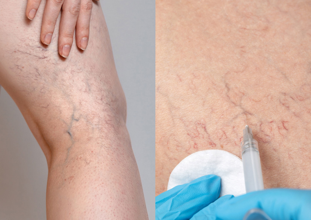 Pure Ästhetik Winnenden: Sklerosierung